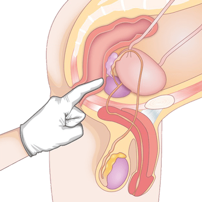 Détermination de l'état de la prostate par palpation pour le diagnostic de prostatite
