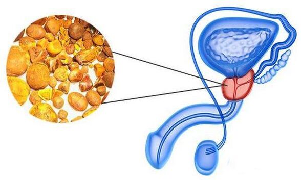 Problèmes de prostatite