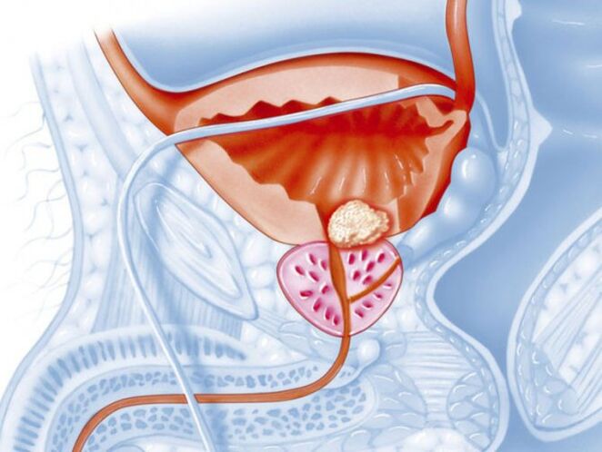 Prostatite bactérienne